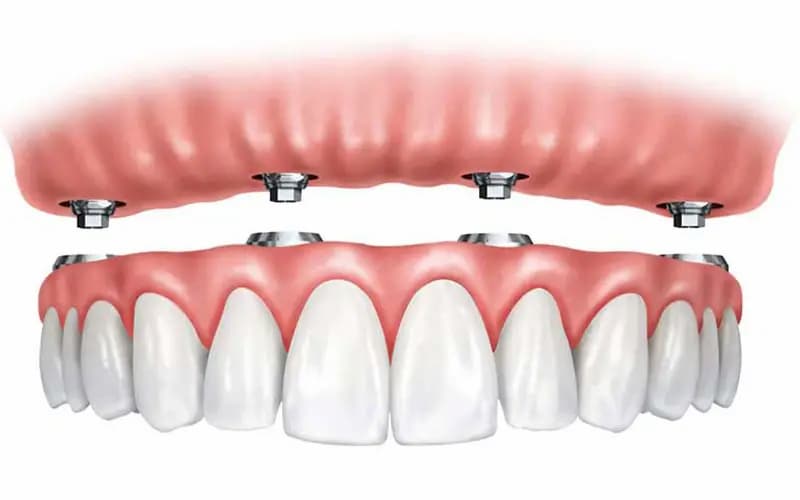 تصویر 4 از خرید و قیمت دندان متحرک + فروش صادراتی